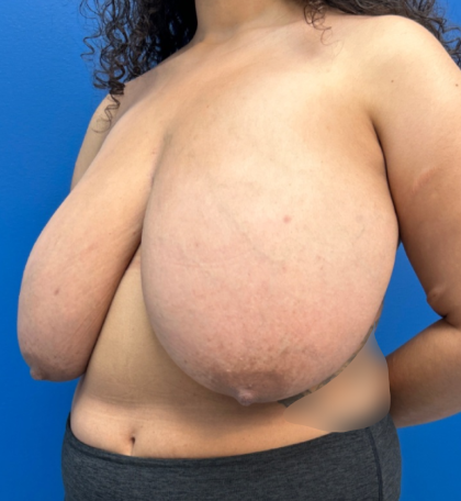 Breast Reduction Before & After Patient #14119