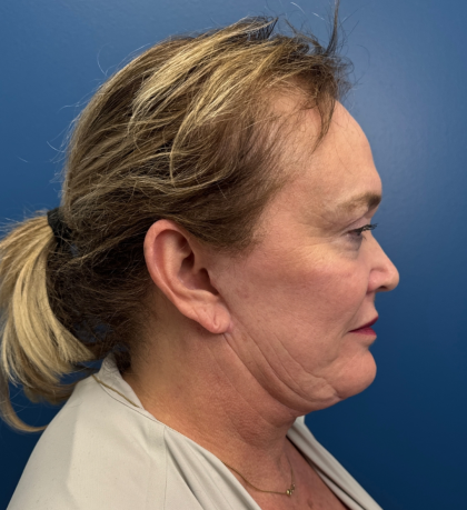 Facelift and Necklift Before & After Patient #14120