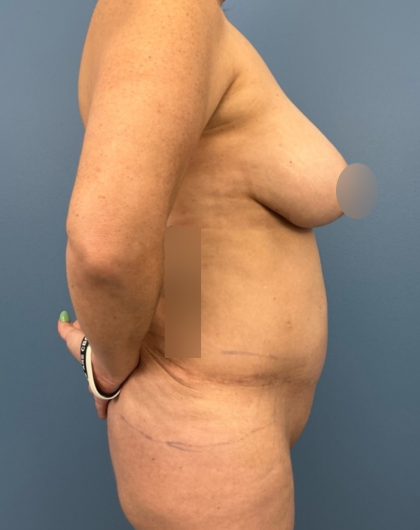 Lower Body Lift Before & After Patient #14173