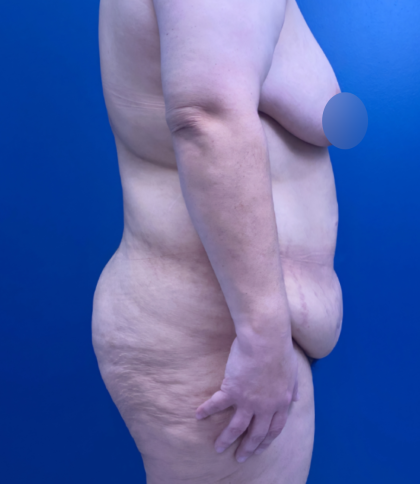 Lower Body Lift Before & After Patient #14186