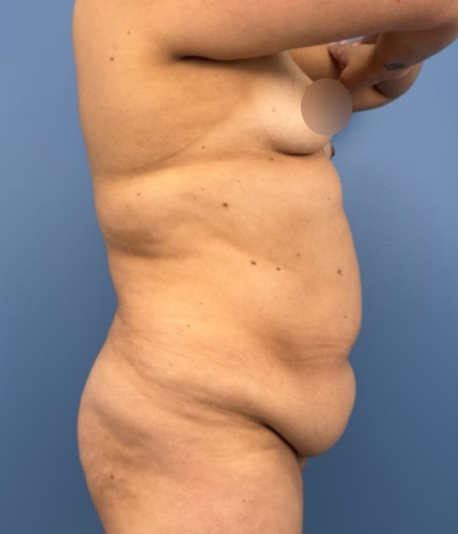 Tummy Tuck Before & After Patient #14208