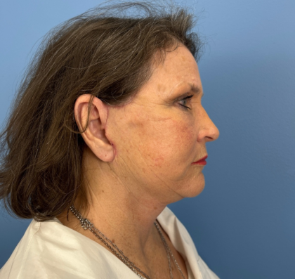 Facial Fat Grafting Before & After Patient #14213
