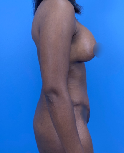 Breast Lift/Mastopexy Before & After Patient #14210
