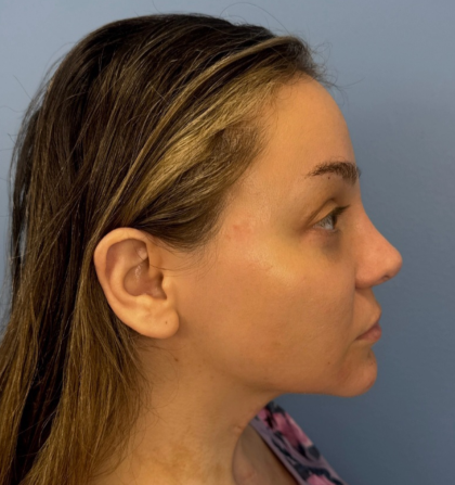 Browlift Before & After Patient #14399