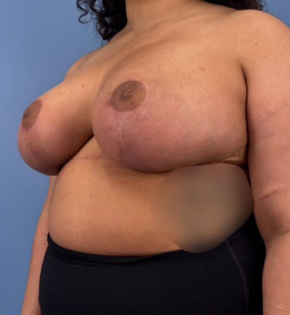 Breast Reduction Before & After Patient #14119