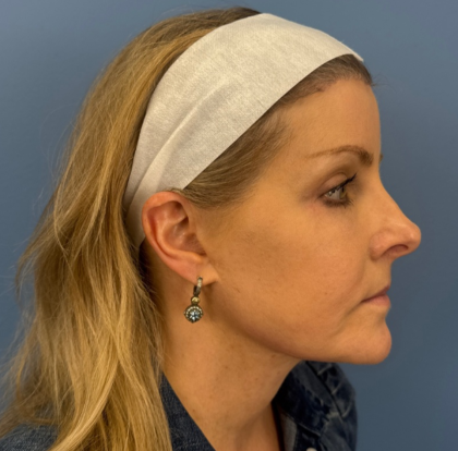 Browlift Before & After Patient #14105