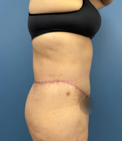 Lower Body Lift Before & After Patient #14186