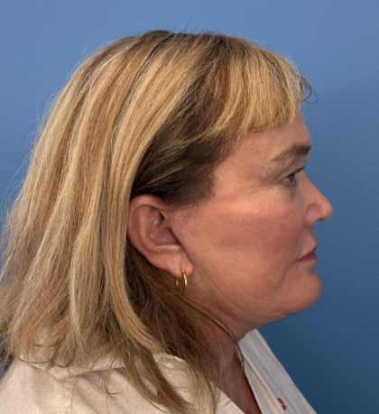 Facial Fat Grafting Before & After Patient #14197