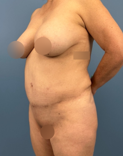 Tummy Tuck Before & After Patient #14116