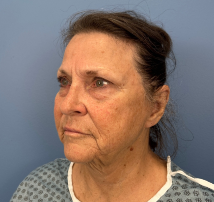 Facial Fat Grafting Before & After Patient #14213