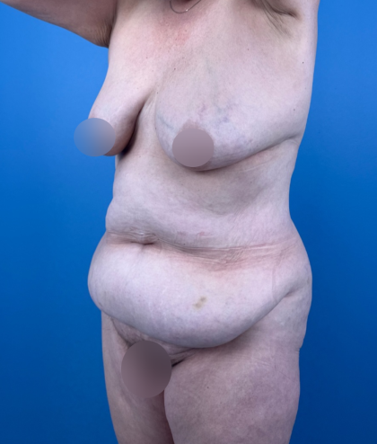 Tummy Tuck Before & After Patient #14258