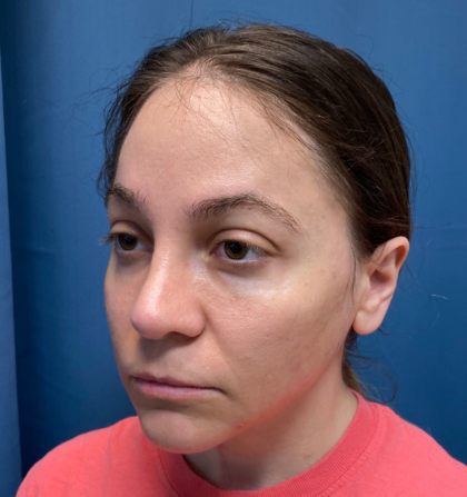 Browlift Before & After Patient #14399