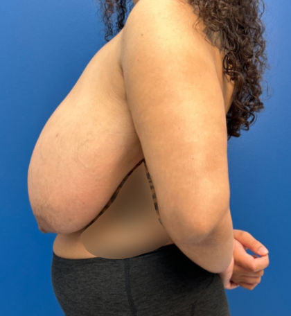 Breast Reduction Before & After Patient #14119