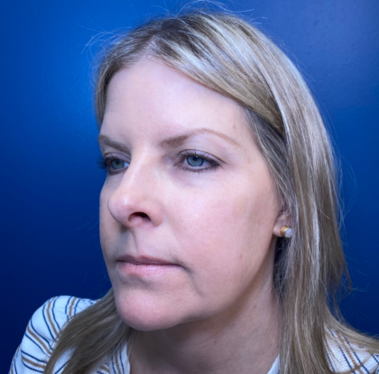 Browlift Before & After Patient #14105