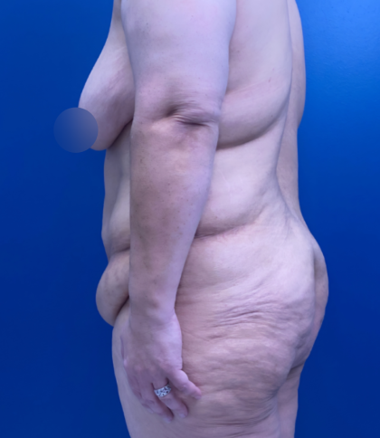 Lower Body Lift Before & After Patient #14186