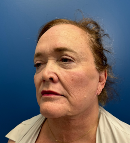 Facial Fat Grafting Before & After Patient #14197