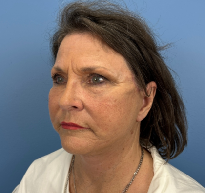 Facelift and Necklift Before & After Patient #14209