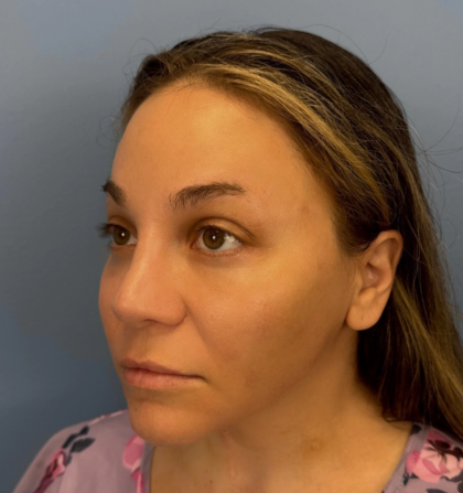 Browlift Before & After Patient #14399
