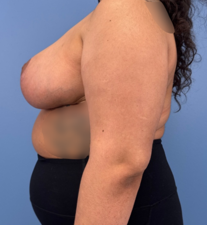 Breast Reduction Before & After Patient #14119