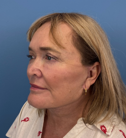 Facelift and Necklift Before & After Patient #14120