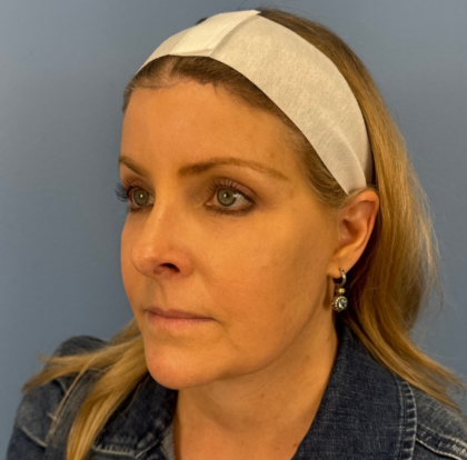 Browlift Before & After Patient #14105