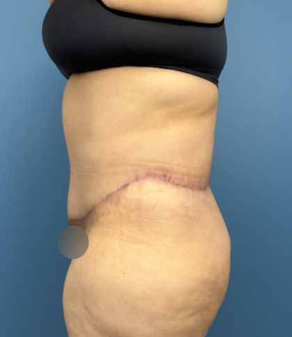 Lower Body Lift Before & After Patient #14186