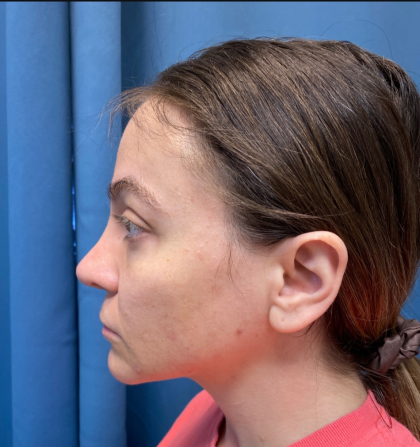 Browlift Before & After Patient #14399