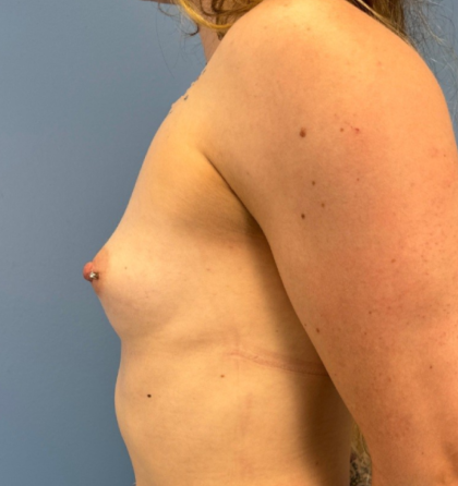 Breast Augmentation Before & After Patient #14122