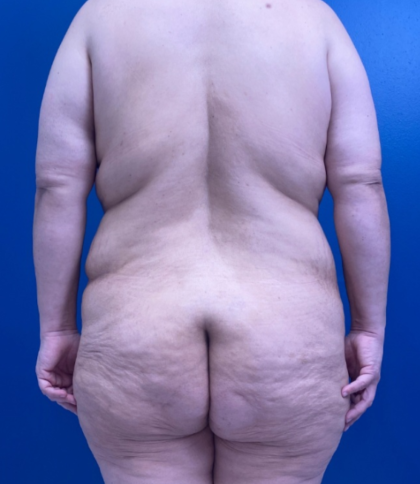 Lower Body Lift Before & After Patient #14186
