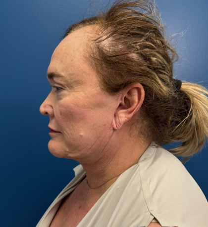 Facial Fat Grafting Before & After Patient #14197