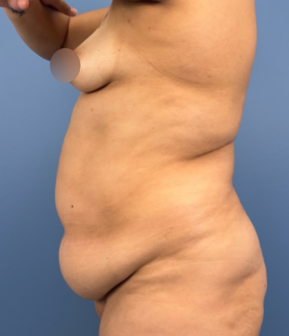 Tummy Tuck Before & After Patient #14208
