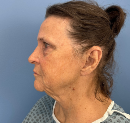 Facelift and Necklift Before & After Patient #14209