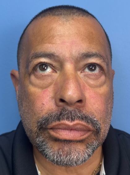 Blepharoplasty Before & After Patient #14428