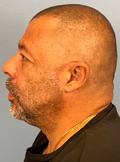 Blepharoplasty Before & After Patient #14428