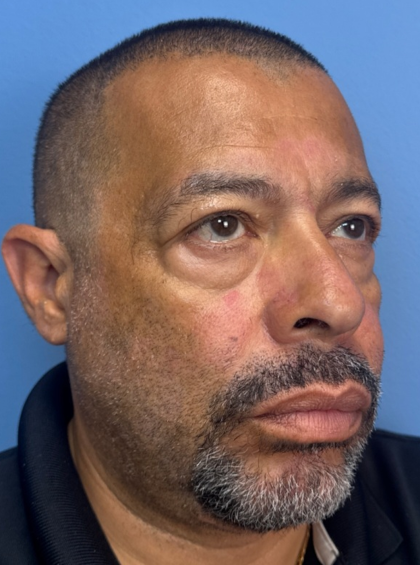 Blepharoplasty Before & After Patient #14428