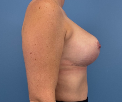 Breast Lift/Mastopexy Before & After Patient #14415