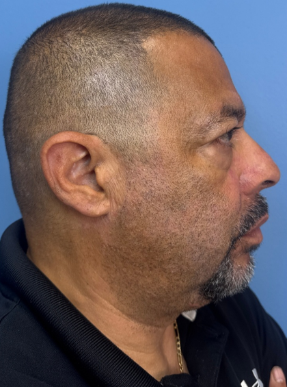 Blepharoplasty Before & After Patient #14428