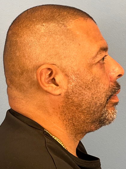 Blepharoplasty Before & After Patient #14428