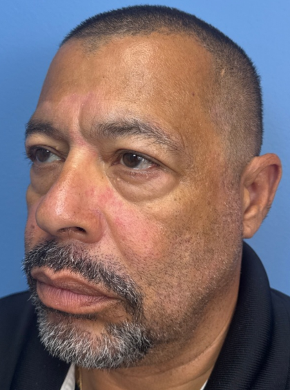 Blepharoplasty Before & After Patient #14428