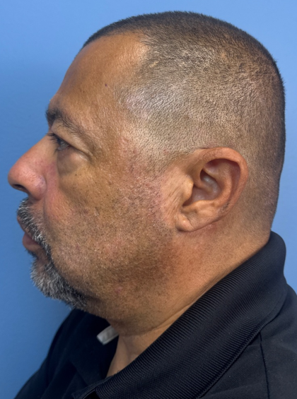 Blepharoplasty Before & After Patient #14428
