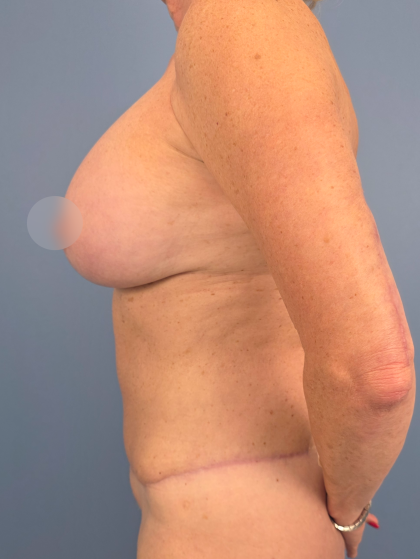 Breast Lift/Mastopexy Before & After Patient #14427