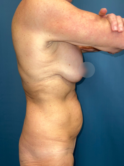 Breast Lift/Mastopexy Before & After Patient #14427