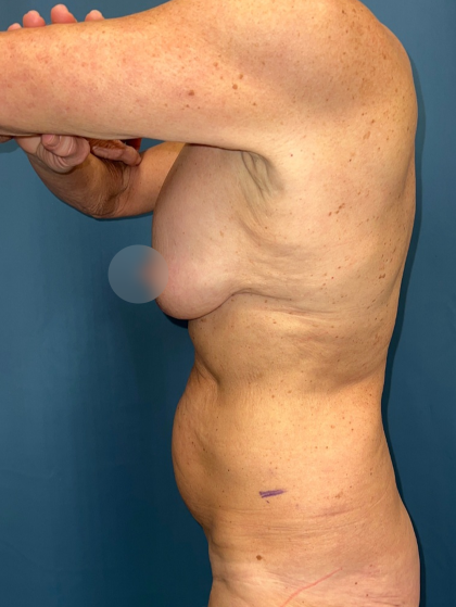 Breast Lift/Mastopexy Before & After Patient #14427