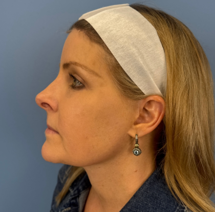Facial Fat Grafting Before & After Patient #15046