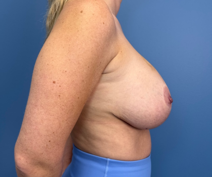 Breast Revision Before & After Patient #14994