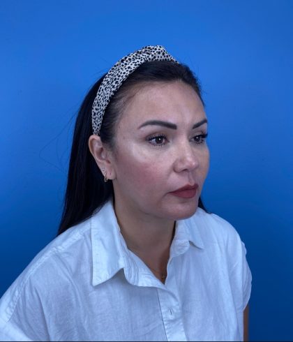 Blepharoplasty Before & After Patient #15034