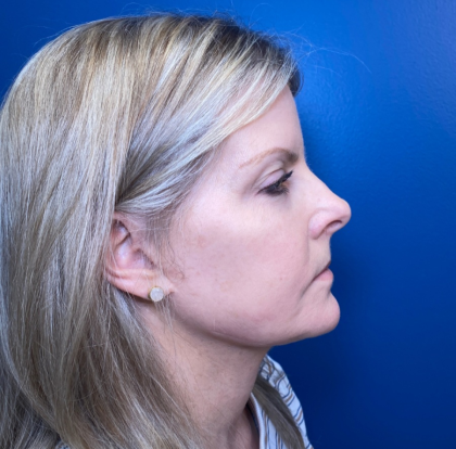 Facial Fat Grafting Before & After Patient #15046