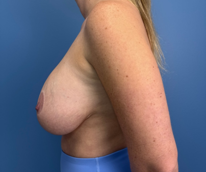 Breast Revision Before & After Patient #14994