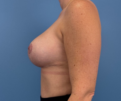 Breast Revision Before & After Patient #14994