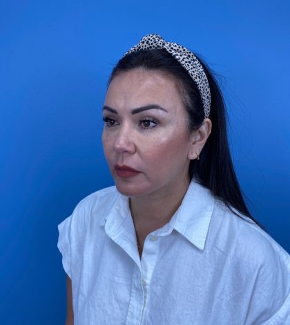 Blepharoplasty Before & After Patient #15034